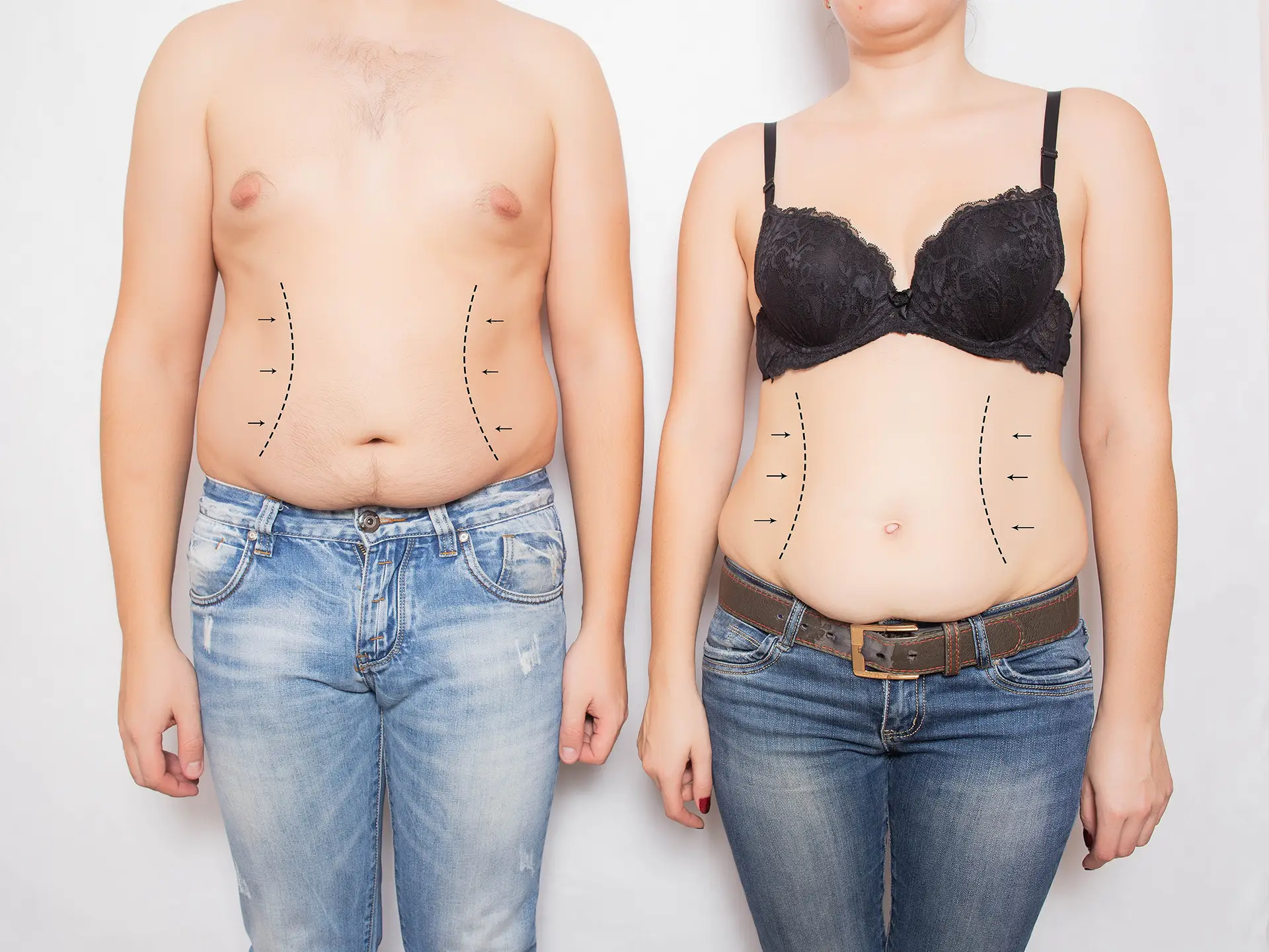 Pacienți — bărbat și femeie — candidați pentru abdominoplastie