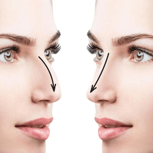 Rinoplastie