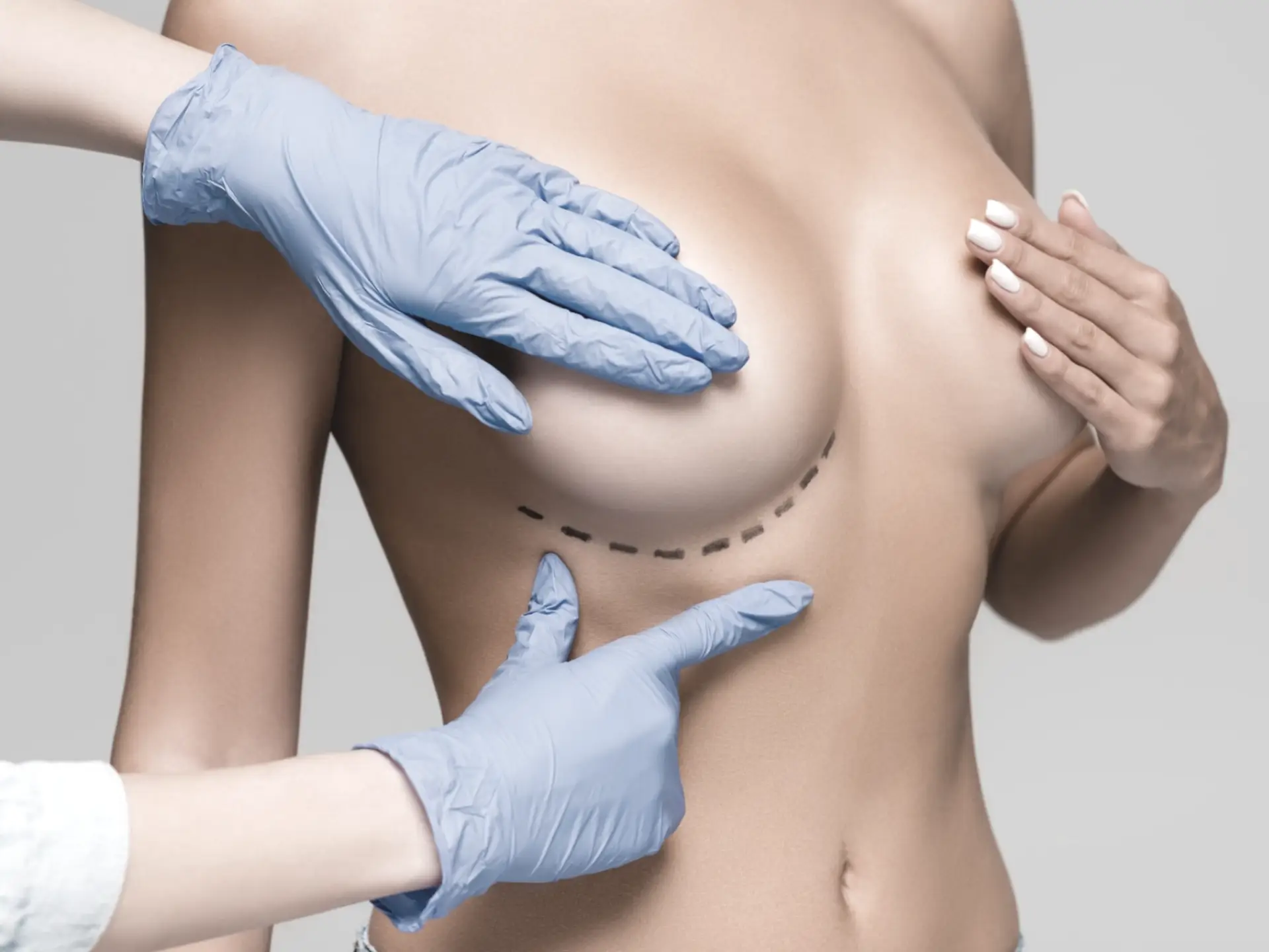 implant mamar in Turcia