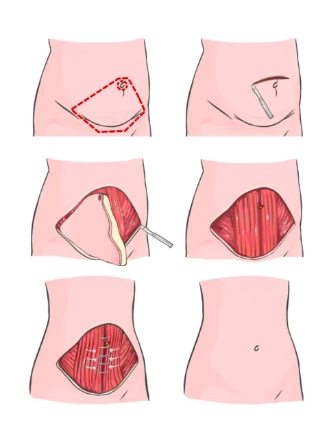 reprezentare grafică procedură medicală de abdominoplastie